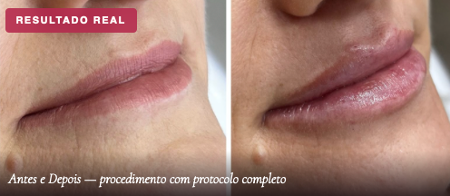 Formação em Preenchimento Labial